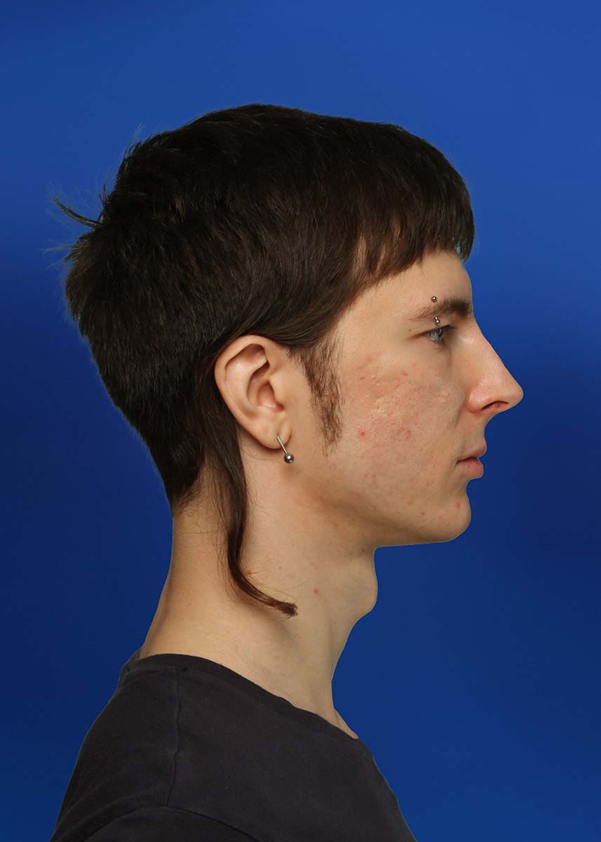 After Rhinoplasty - Front View